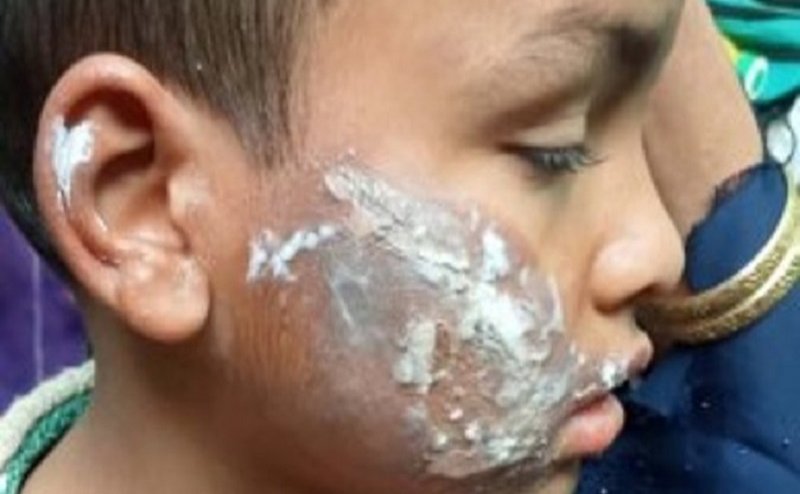 सात साल के सौतेले बेटे के चेहरे और पीठ पर मां ने रखा गरम प्रेस, पिता ने दर्ज करायी शिकायत