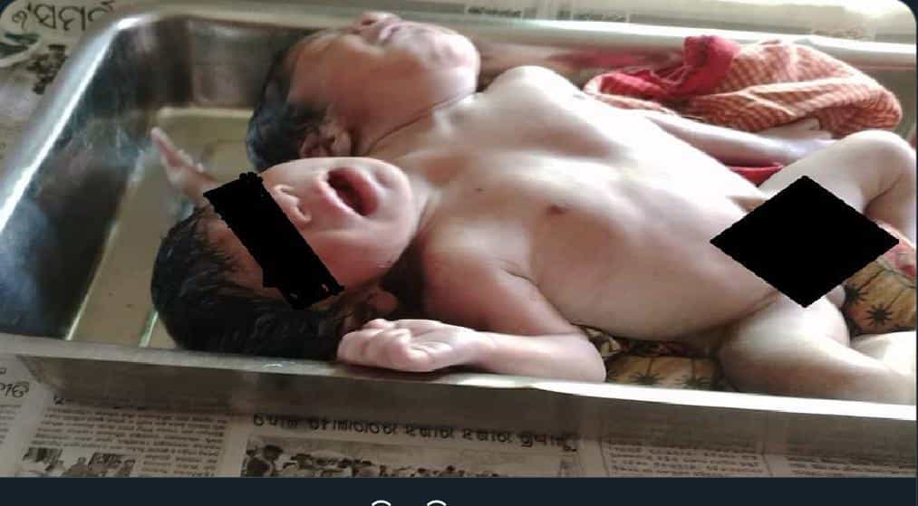 Odisha woman gives birth to twins with 2 heads and 3 hands